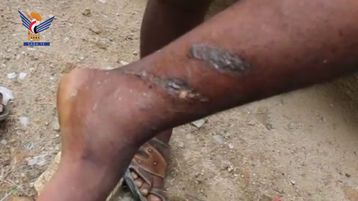 Un ciudadano murió y otros seis resultaron heridos en los distritos de Dhahir y Haidan debido a torturas perpetradas por el ejército saudíta